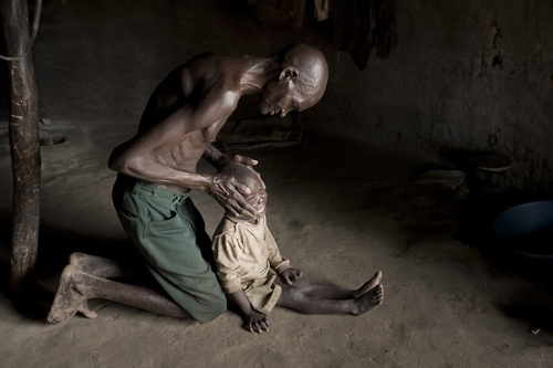 mal-acholi-ouganda